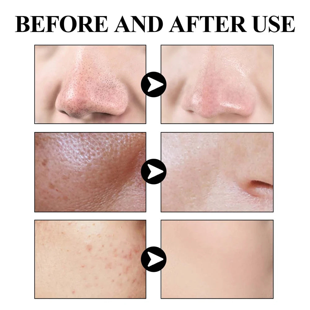 West Month Blackhead Mud Mask Oil Control Treatment